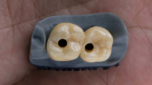 Multiple Dental Implants Vs  Dental Bridge