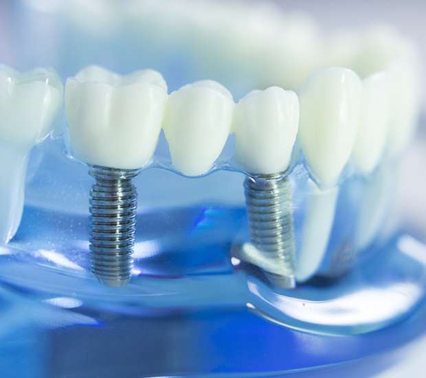 Quincy Dental Implants