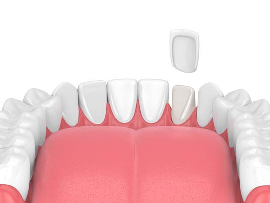 A Dental Veneer &#    ; Solution For A Broken Tooth