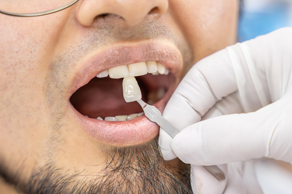 Can Dental Veneers Fix Chipped, Stained, Or Uneven Teeth?