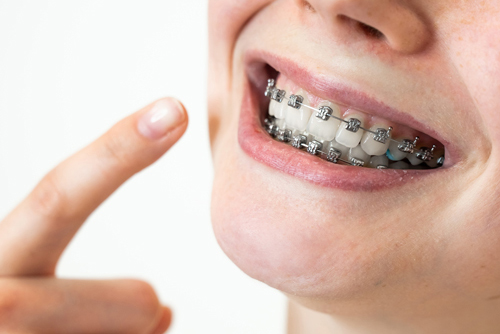 Orthodontics Timeline: From Braces To Beautiful Teeth